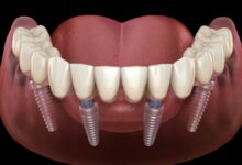 Transform Your Smile with All On 4 Dental Implants A Complete Guide