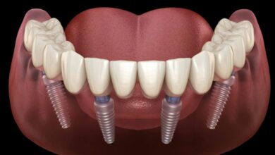 Transform Your Smile with All On 4 Dental Implants A Complete Guide