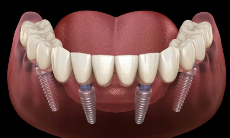 Transform Your Smile with All On 4 Dental Implants A Complete Guide