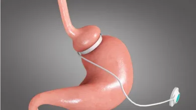 Transform Your Life with Gastric Bypass Surgery in Sydney A Comprehensive Guide