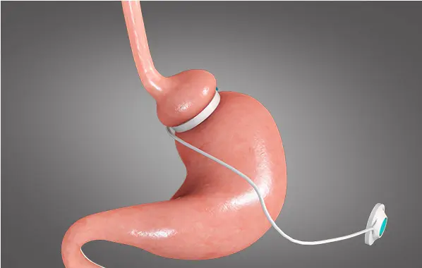 Transform Your Life with Gastric Bypass Surgery in Sydney A Comprehensive Guide