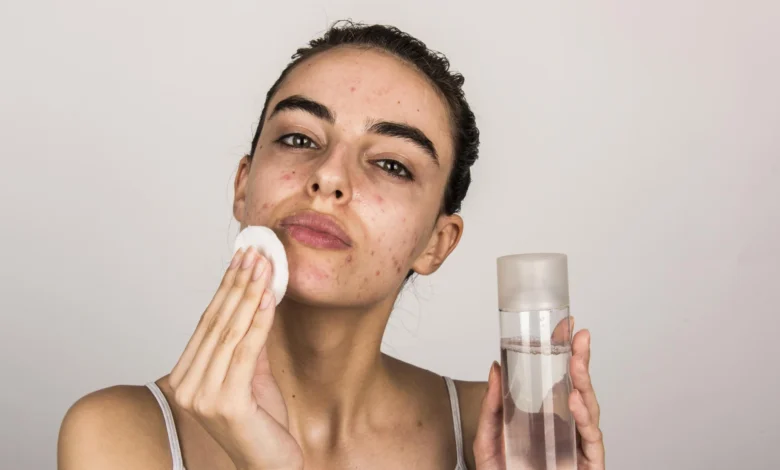 Effective Skin Care Range for Acne: How Synergie Skin Transforms Acne-Prone Complexions